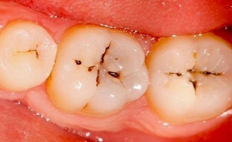 Những đốm đen bắt đầu xuất hiện trên răng.