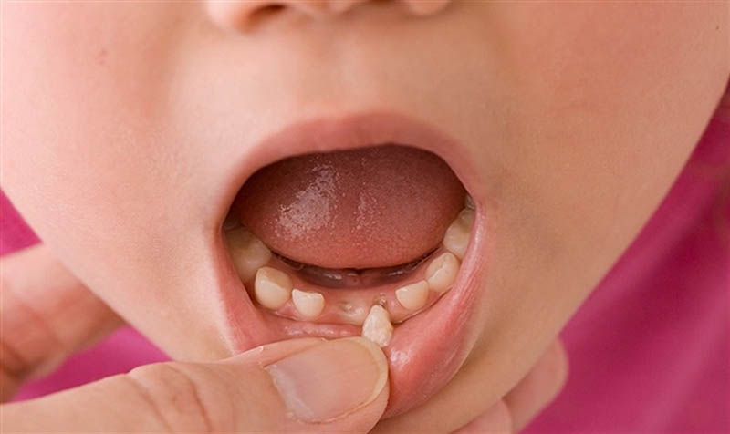 Hướng dẫn chi tiết quy trình nhổ răng sữa cho bé
