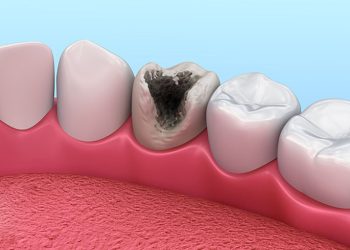 Quá trình sâu răng diễn ra thế nào?