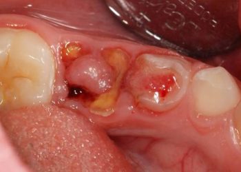 Răng sâu lồi thịt chảy máu gây ảnh hưởng không nhỏ tới sinh hoạt của người bệnh.
