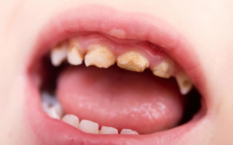 Răng bị sâu có thể gây mất thẩm mỹ