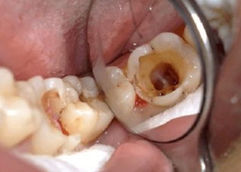 Sâu răng khiến chức năng ăn nhai bị ảnh hưởng trực tiếp