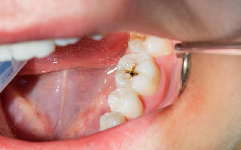 Những trường hợp nếu bị sâu răng nặng có thể cần sử dụng các biện pháp chuyên khoa để xử lý