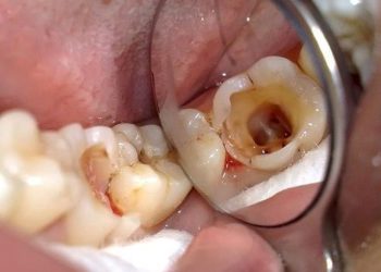 Sâu răng hàm ăn vào tủy là bệnh lý thường gặp hiện nay.