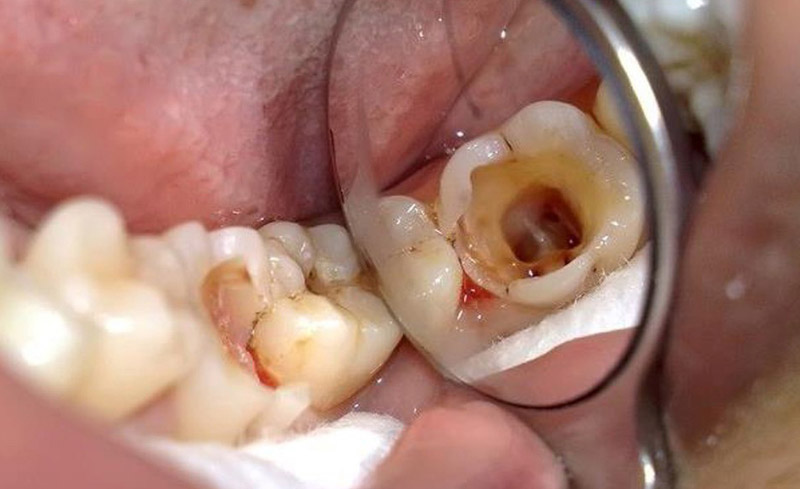 Sâu răng hàm ăn vào tủy là bệnh lý thường gặp hiện nay.