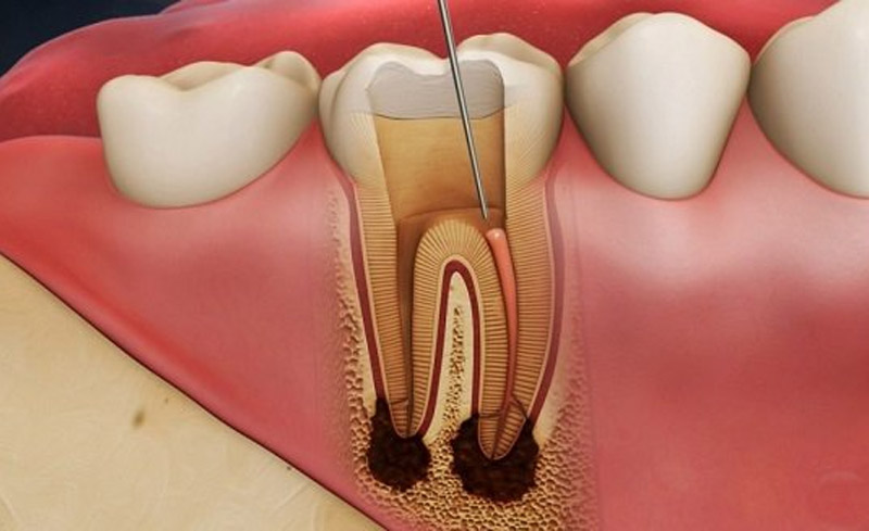 Phương pháp chữa tủy răng bị sâu.