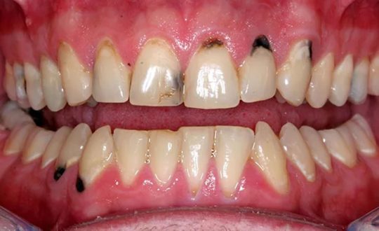 Bệnh sâu răng có chữa khỏi được không là câu hỏi nhiều người quan tâm.