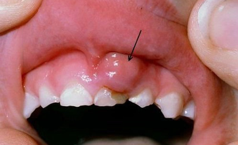 Bệnh răng sâu có mủ là bệnh răng miệng khá phổ biến.