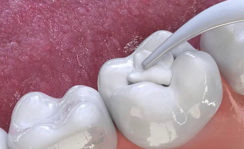 Điều trị sâu răng có mủ bằng phương pháp trám răng