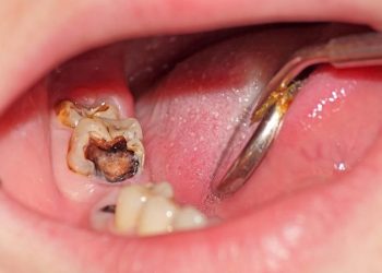 Sâu răng hàm thường gặp ở cả trẻ em và người lớn
