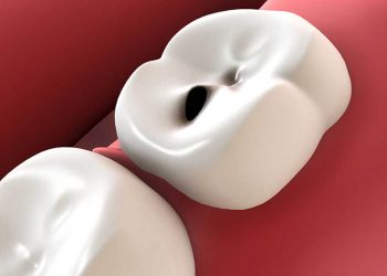 Bệnh sâu răng không thể tự khỏi
