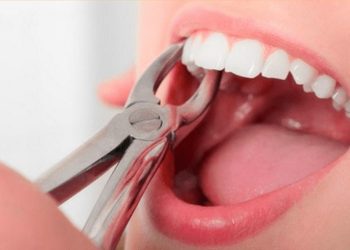 Nhổ răng có thể sẽ dẫn đến tiêu xương, biến dạng khuôn mặt