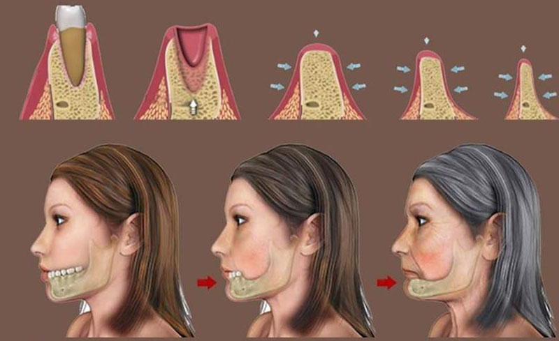 Nhổ răng có thể sẽ dẫn đến tiêu xương, biến dạng khuôn mặt