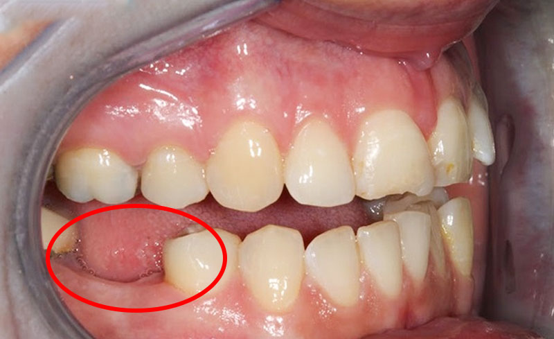 Sâu chân răng số 6 là vấn đề nhiều người gặp phải hiện nay