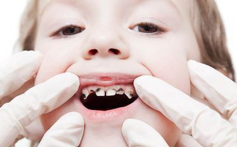 Hình ảnh sâu răng ở trẻ em