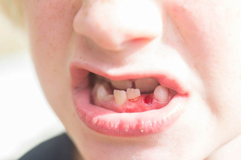 Khi sâu răng sữa không được kiểm soát, hàm răng vĩnh viễn của trẻ có thể bị xô lệch