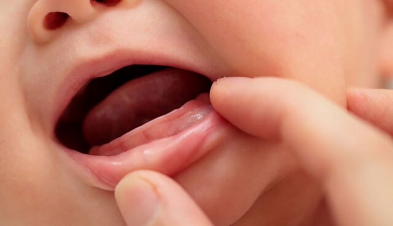 Trẻ chậm mọc răng là tình trạng mà nhiều bé gặp phải hiện nay
