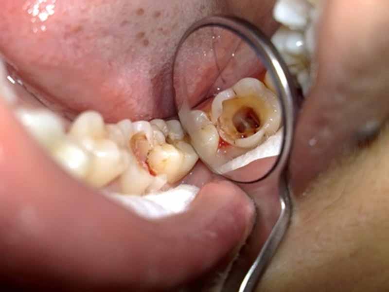 Nhổ răng là biện pháp hiệu quả nhất với những trường hợp bị sâu nặng