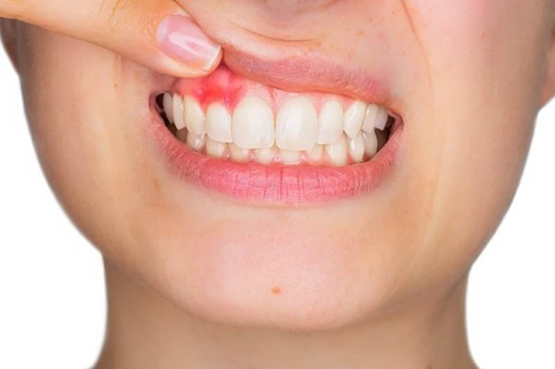  Người đang bị viêm nha chu không nên lấy cao răng 