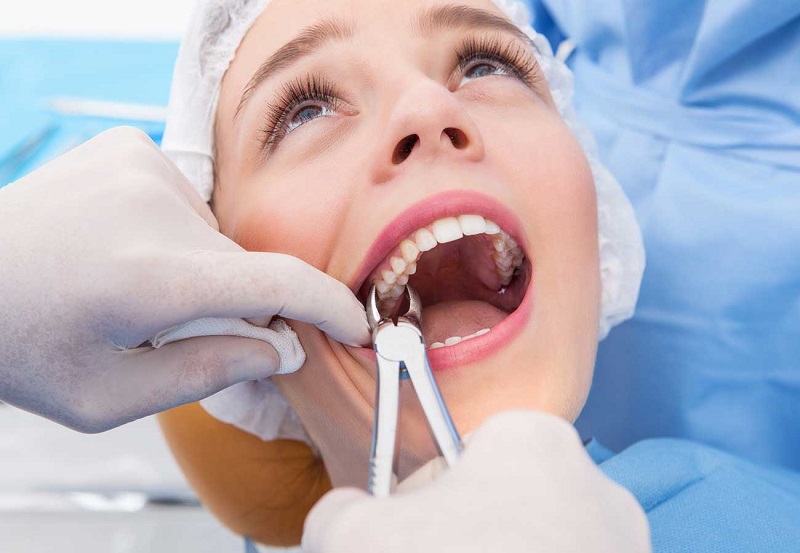 Nhiều trường hợp có thể phải tiến hành nhổ răng, để không ảnh hưởng đến xung quanh