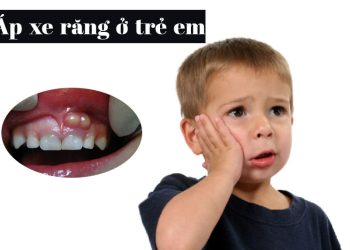 Áp xe răng thường gặp ở trẻ em giai đoạn thay răng