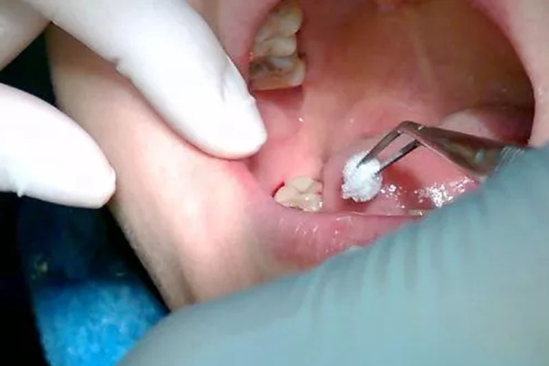 Thủ thuật chữa áp xe răng cần thực hiện bởi bác sĩ có chuyên môn
