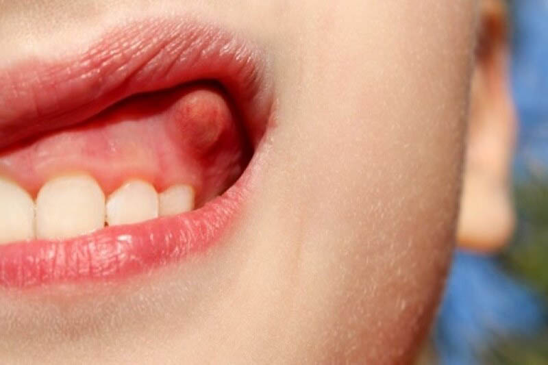 Bị áp xe nướu răng là bệnh lý mà nhiều người dễ gặp phải