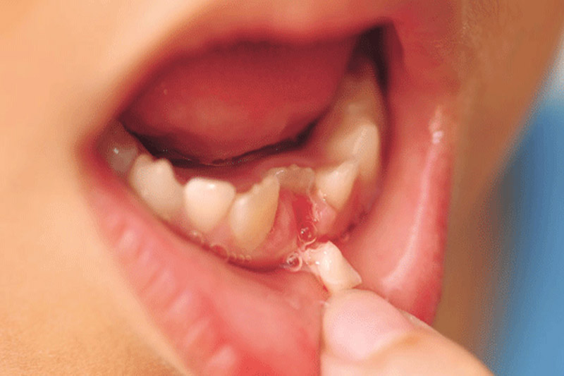 Mọc răng muộn có thể sẽ gây ra hiện tượng răng mọc lệch sau này ở bé