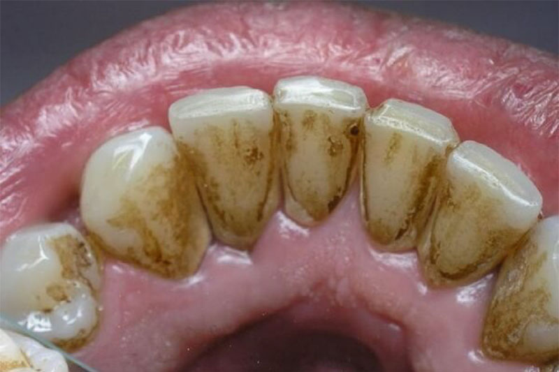 Mảng cao răng trong miệng có thể nhìn thấy với mắt thường.