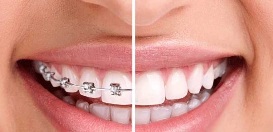 Tổng hợp các loại niềng răng phổ biến nhất hiện nay