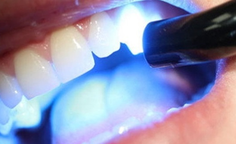 Trám răng bằng công nghệ laser tech có độ an toàn cao.