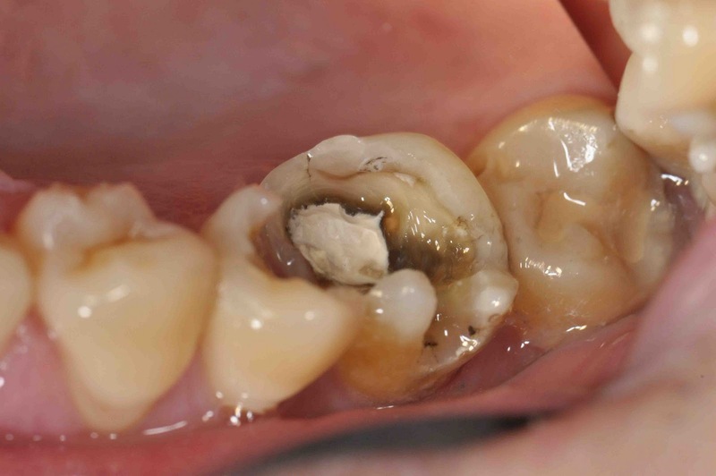 Bệnh sâu răng khi ăn đồ ngọt khiến người bệnh cảm thấy bị đau nhức răng
