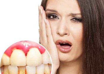 Hôi miệng chảy máu chân răng chữa trị như thế nào hiệu quả?