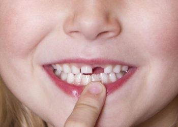Không nên cưỡng ép nhổ răng sớm 