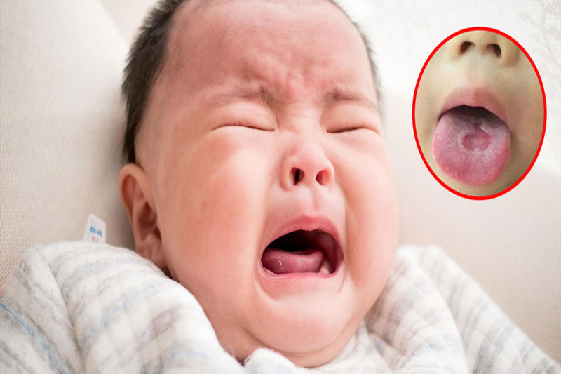 Trẻ bị nấm miệng thường xuyên quấy khóc, khó khăn khi nuốt dẫn đến bỏ bú