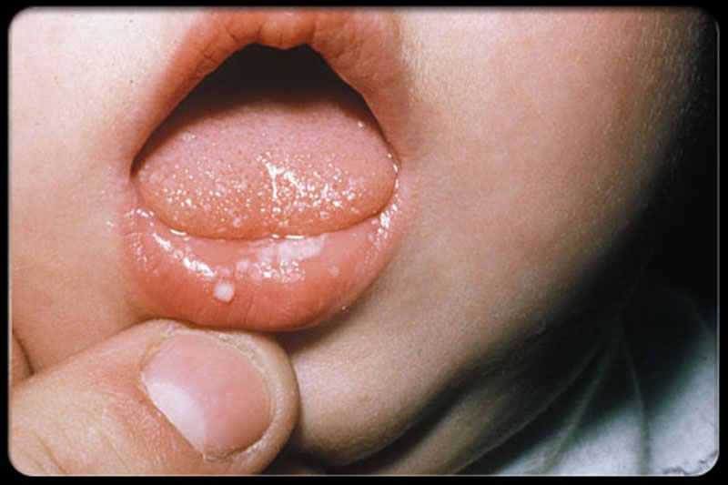 Nấm miệng ở trẻ nhỏ là bệnh khá phổ biến, ít nguy hiểm