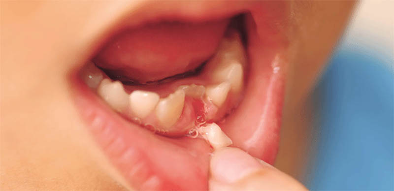 Có nên nhổ răng sữa chưa lung lay của trẻ hay không?