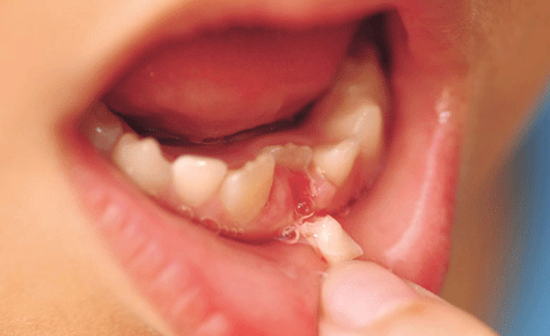 Nhổ răng sữa sót chân răng là tình trạng không hiếm gặp ở trẻ trong giai đoạn thay răng