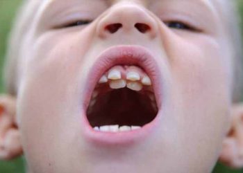 Có nên nhổ răng sữa mọc lệch cho trẻ?