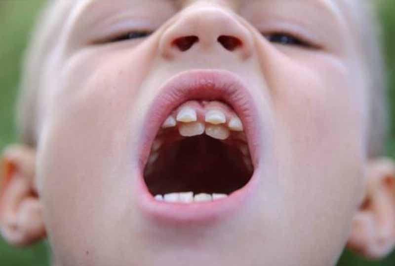 Có nên nhổ răng sữa mọc lệch cho trẻ?