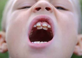 Răng trẻ mọc lẫy phải khắc phục như thế nào?