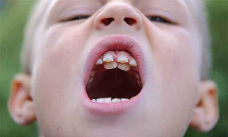 Răng trẻ mọc lẫy phải khắc phục như thế nào?