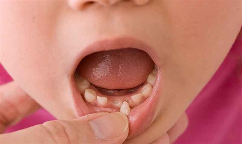 Có rất nhiều nguyên nhân gây nên tình trạng răng mọc lẫy ở trẻ