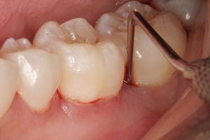 Sâu kẽ trong răng hàm