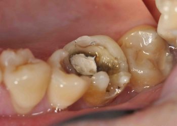 Tình trạng sâu răng nổi hạch gặp phải khi vi khuẩn phát triển mạnh trong khoang miệng