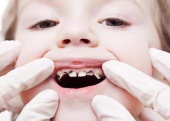 Sún răng: Nguyên nhân, cách chữa trị và phòng ngừa
