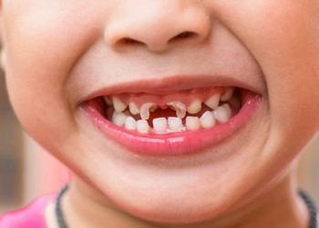 Sún răng cửa là hiên tượng thường gặp ở trẻ nhỏ giai đoạn thay răng
