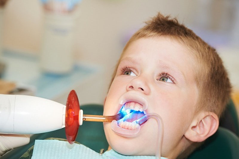 Hàn trám răng cửa sún cho trẻ khi đến nha sĩ