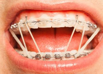 Dây thun niềng răng được sử dụng để tác động lực kéo đưa răng về vị trí mong muốn.