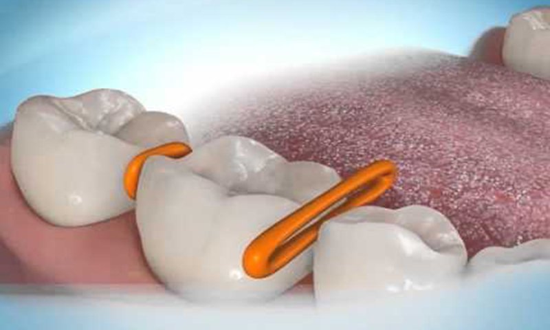 Thun tách kẽ tạo ra khe hở giữa các răng hàm để dễ dàng lắp đặt dây cung và mắc cài.